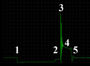 Primary voltage waveform from a DIS ignition system