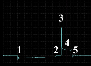 Secondary waveform from a DIS ignition system