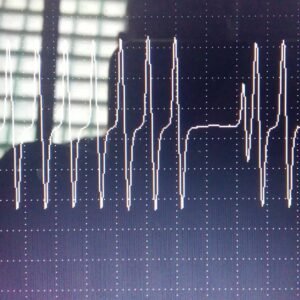 Iveco Stralis 2012 failed crankshaft position sensor waveform zoomed