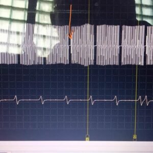 Iveco Stralis 2012 failed crankshaft position sensor waveform
